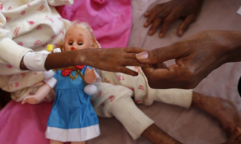 The bony hand of Kaukab Ahmed, a nine-year-old Yemeni girl inflicted with acute malnutrition, is seen inside the malnutrition ward in the al-Sabeen hospital, Sanaa, Yemen on Aug. 18, 2021.(Photo: Xinhua)