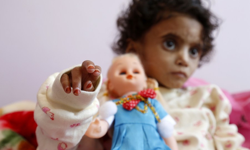 Kaukab Ahmed, a nine-year-old Yemeni girl inflicted with acute malnutrition, is seen inside the malnutrition ward in the al-Sabeen hospital, Sanaa, Yemen on Aug. 18, 2021.(Photo: Xinhua)