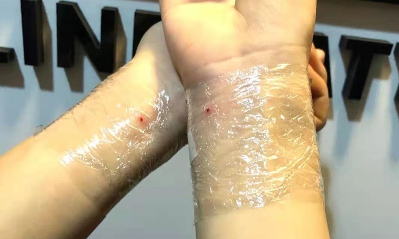 Dark Spot Remover Mole Tattoo, For Clinical Purpose, Laser Treatment at Rs  900/piece in Vijayawada