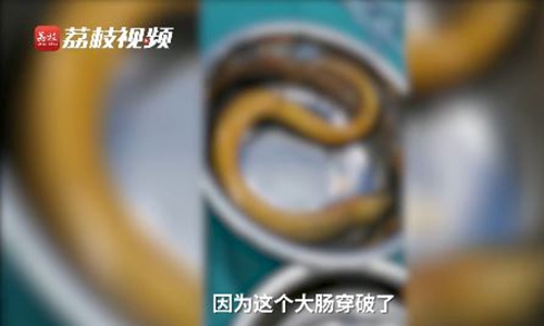Man Inserts Eel Into Rectum From Anus In Hopes To ‘relieve Constipation’ Global Times