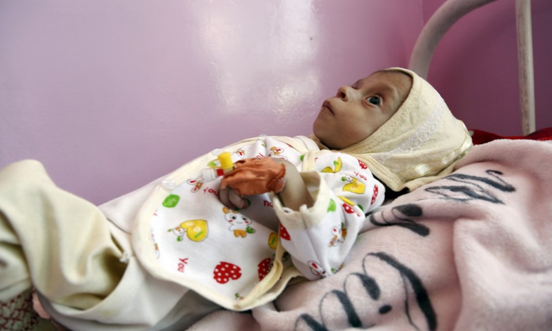 A malnourished Yemeni child receives medical treatment at a hospital in Sanaa, Yemen, on Feb. 27, 2023.(Photo: Xinhua)