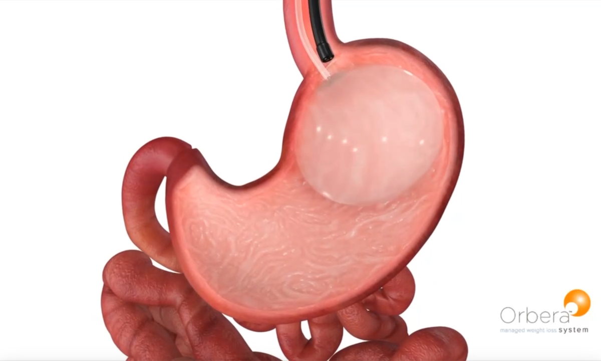 Illustration of Orbera Intragastric Balloon Photo: Courtesy of Boston Scientific