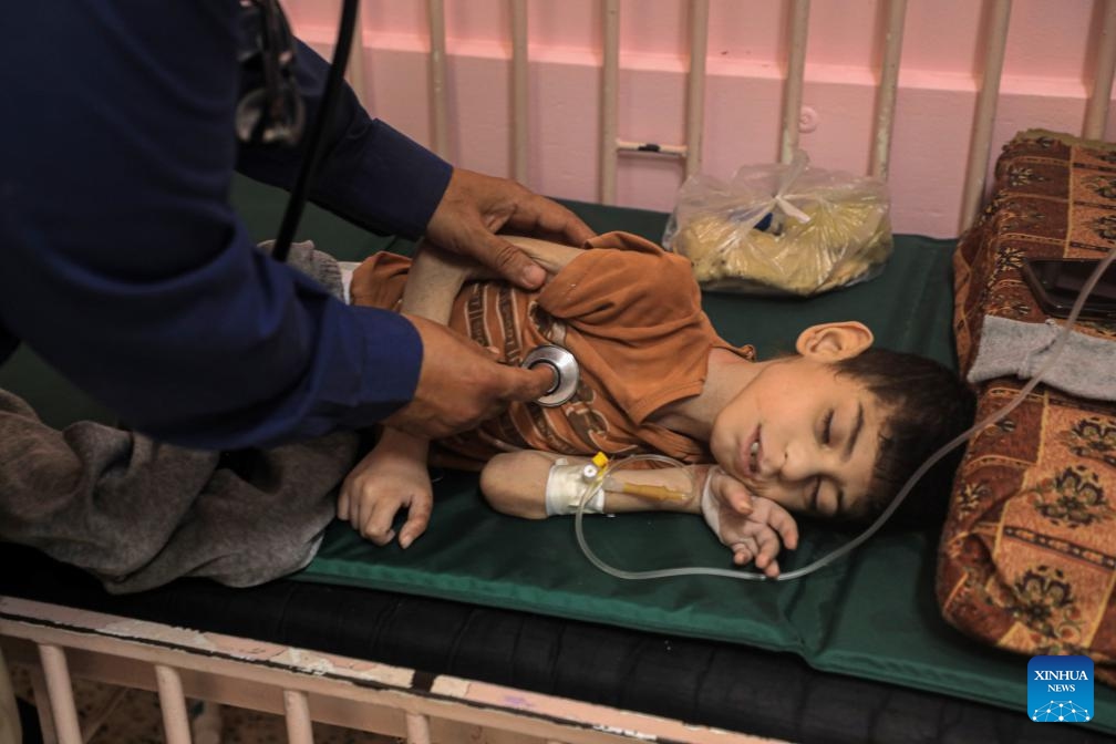 A Palestinian child suffering from malnutrition is treated at the Nasser Hospital in the southern Gaza Strip city of Khan Younis, on June 19, 2024. Malnutrition has threatened the lives of 3,500 children in the Gaza Strip, the Hamas media office said in a press statement on Tuesday. (Photo: Xinhua)