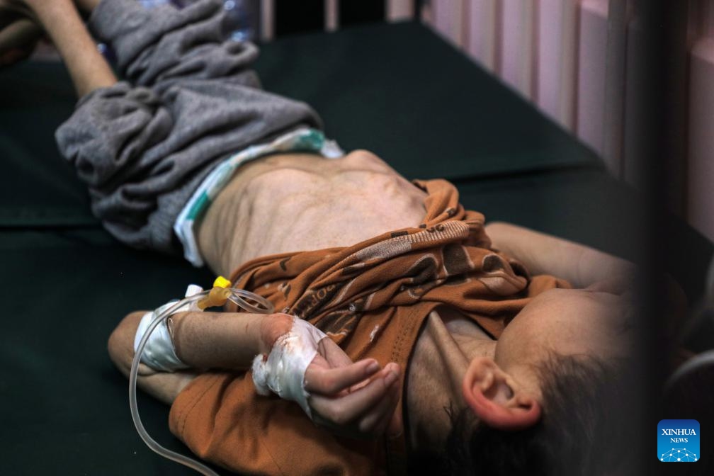 A Palestinian child suffering from malnutrition is seen at the Nasser Hospital in the southern Gaza Strip city of Khan Younis, on June 19, 2024. Malnutrition has threatened the lives of 3,500 children in the Gaza Strip, the Hamas media office said in a press statement on Tuesday. (Photo: Xinhua)