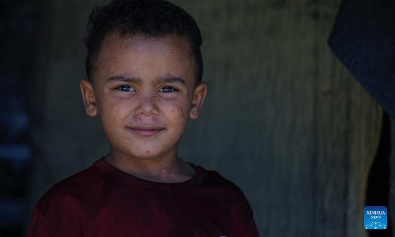 A child infected with skin disease is pictured in the southern Gaza Strip city of Khan Younis, on Aug. 6, 2024. (Photo: Xinhua)