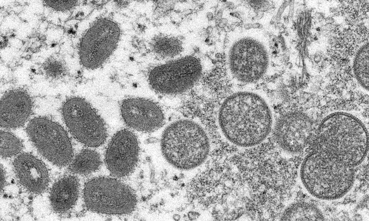 Monkeypox virus particles under a microscope made available by the Centers for Disease Control and Prevention  Photo： VCG