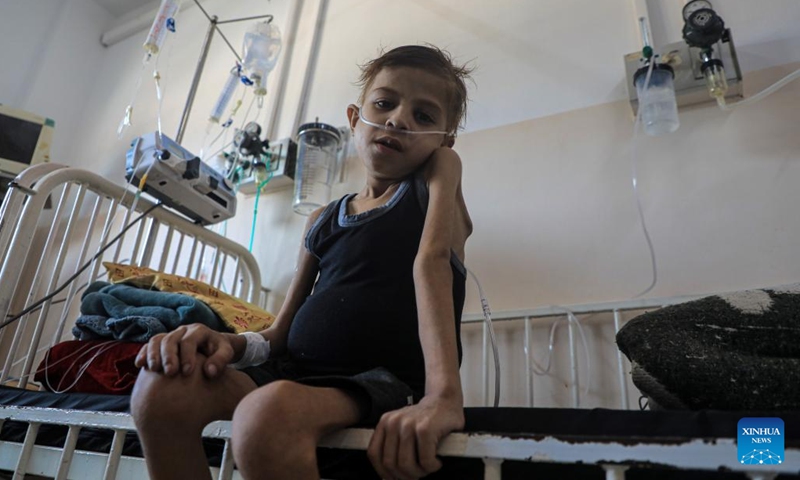 A child patient receives treatment at Nasser Hospital in the southern Gaza Strip city of Khan Younis, Aug. 19, 2024. (Photo: Xinhua)